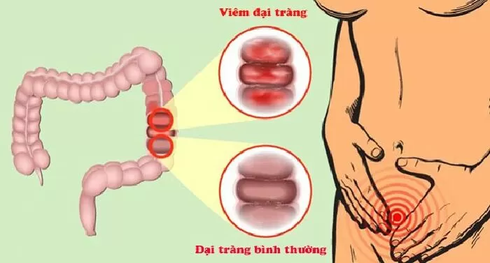 Viêm đại tràng