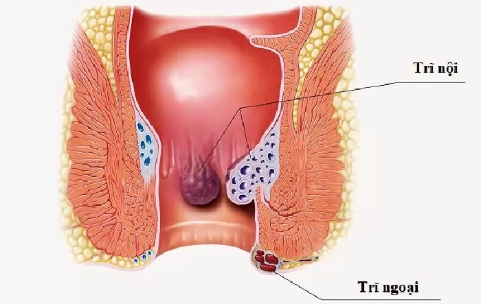Trĩ