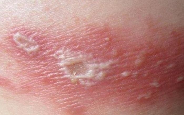 Cure shingles