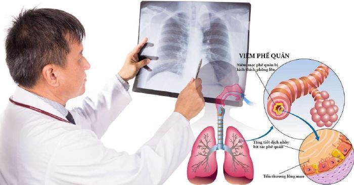 Supporting the treatment of chronic tracheitis